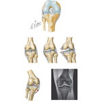 Collateral Ligaments