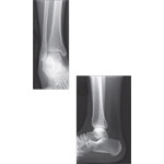 Radiographic Anatomy of the Ankle