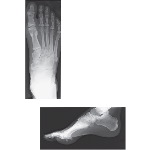 Radiographic Anatomy of the Foot