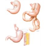 Surgical Options In Obesity