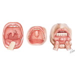 Common Oral Lesions