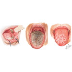 Common Oral Lesions