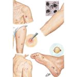 Common Skin Disorders of Travelers