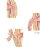 Types of Stomas: Complications