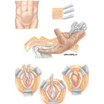 Types of Stomas: Ileostomy Incision Technique