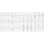 ECG Changes of LV Hypertrophy