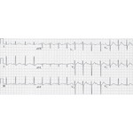 Congenital Long QT Syndrome