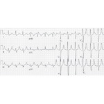 Changes Associated With Hyperkalemia
