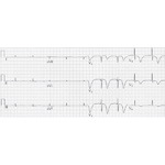 T-Wave Changes Induced By a Recent Ischemic Event
