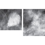 Mammograms