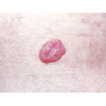 Nodular Basal Cell Carcinoma