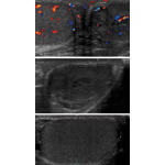 Ultrasound Findings In the Testicle