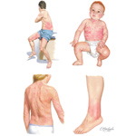 Cutaneous Findings In Disorders of the Immune System