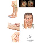 Joint and Central Nervous System Findings In Autoinflammatory Syndromes