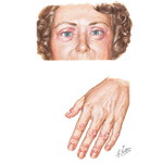 Classic Cutaneous Findings of Dermatomyositis