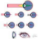 Myopia and Other Refractive Errors