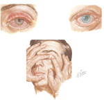 Iritis