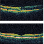 Ocular Coherence Tomograms
