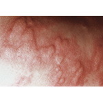 Urticaria