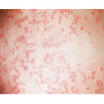 Annular and Serpiginous Urticaria
