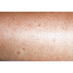 Cholinergic Urticaria