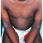 Atopic Dermatitis