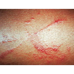 Contact Dermatitis