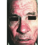 Seborrheic Dermatitis