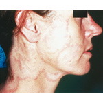Tinea Faciei