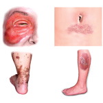 Allergic Contact Dermatitis