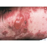 Bullous Pemphigoid