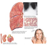 Lung Involvement In Scleroderma