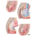 Anorectal Disorders: Surgical Management of Rectal Prolapse