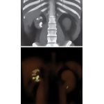 Kidneys and Ureters