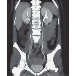 Ureters