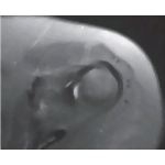 Anterior View of the Shoulder Girdle