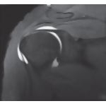 Shoulder Joint, Biceps Tendon