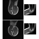 Biceps and Brachialis Insertions