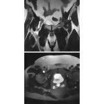 Iliopectineal Bursa