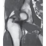 Gluteal Region