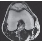 Knee Joint, Superior View