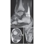 Achilles' Tendon