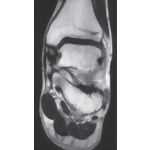 Deltoid Ligament