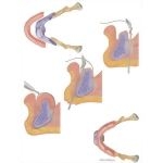 Facial Trauma: Repair of Edentulous Mandible