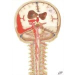 Rupture of Cerebral Aneurysms: Central Nervous System Pathology