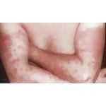 Solar Urticaria