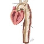 Aortic Aneurysm