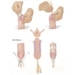 Nosocomial Infections: Technique of Urethral Catheterization In the Male