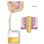 Nosocomial Infections: Sepsis Associated With Indwelling Urinary Catheters