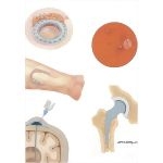 Nosocomial Infections: Prosthetic Devices and Infections